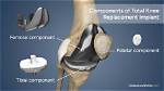 Does Total Knee Replacement Include Kneecap?