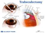 Does Trabeculectomy Cure Glaucoma?