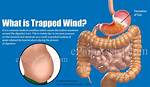 Does Trapped Wind Cause Nausea?