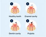 Does Treating Cavities Hurt?