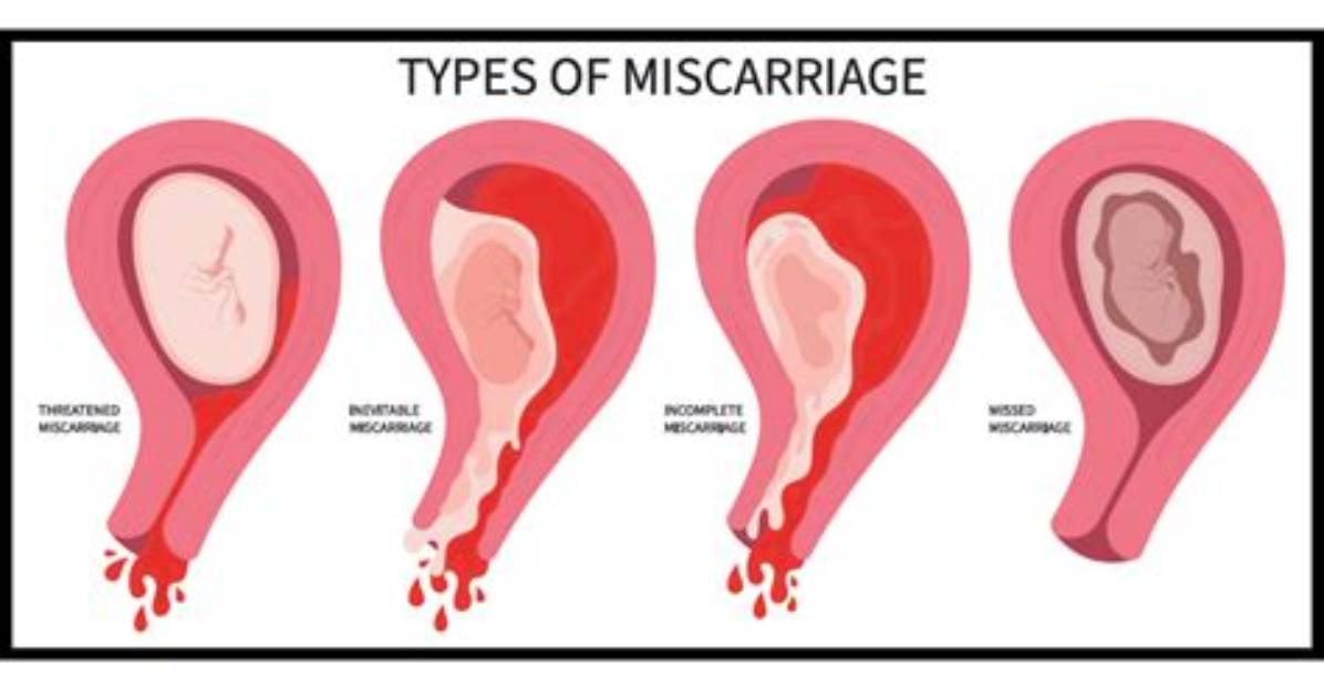 Does Two Miscarriages Row Mean?