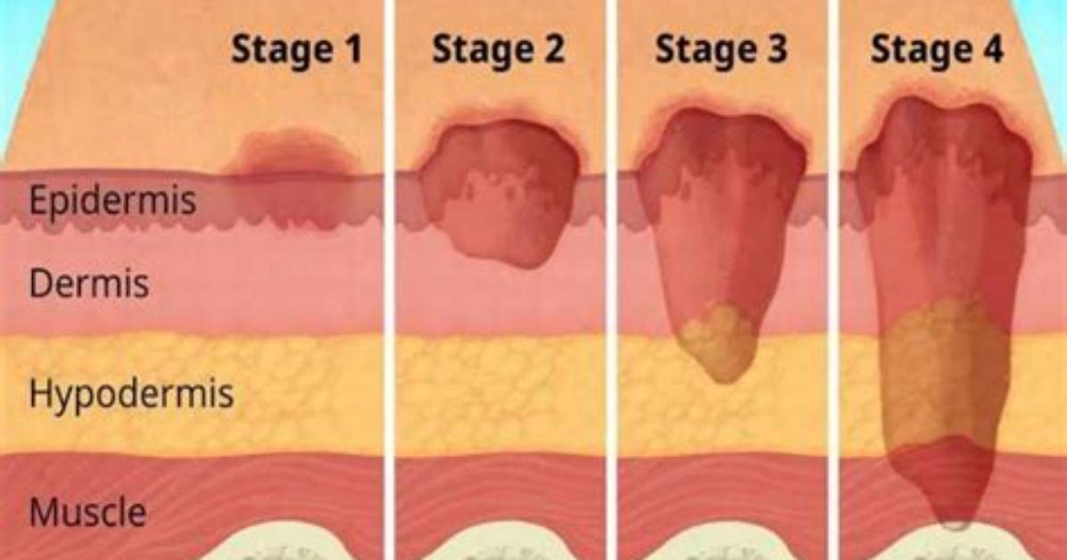 Does Ulcer Has Cure?