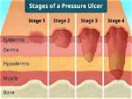 Does Ulcer Has Cure?