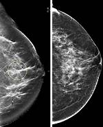 Does Unclear Mammogram Mean?