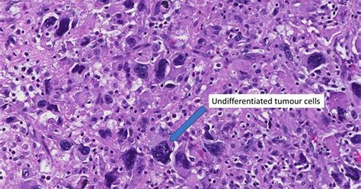 Does Undifferentiated Cell Mean?