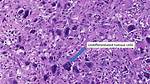 Does Undifferentiated Cell Mean?