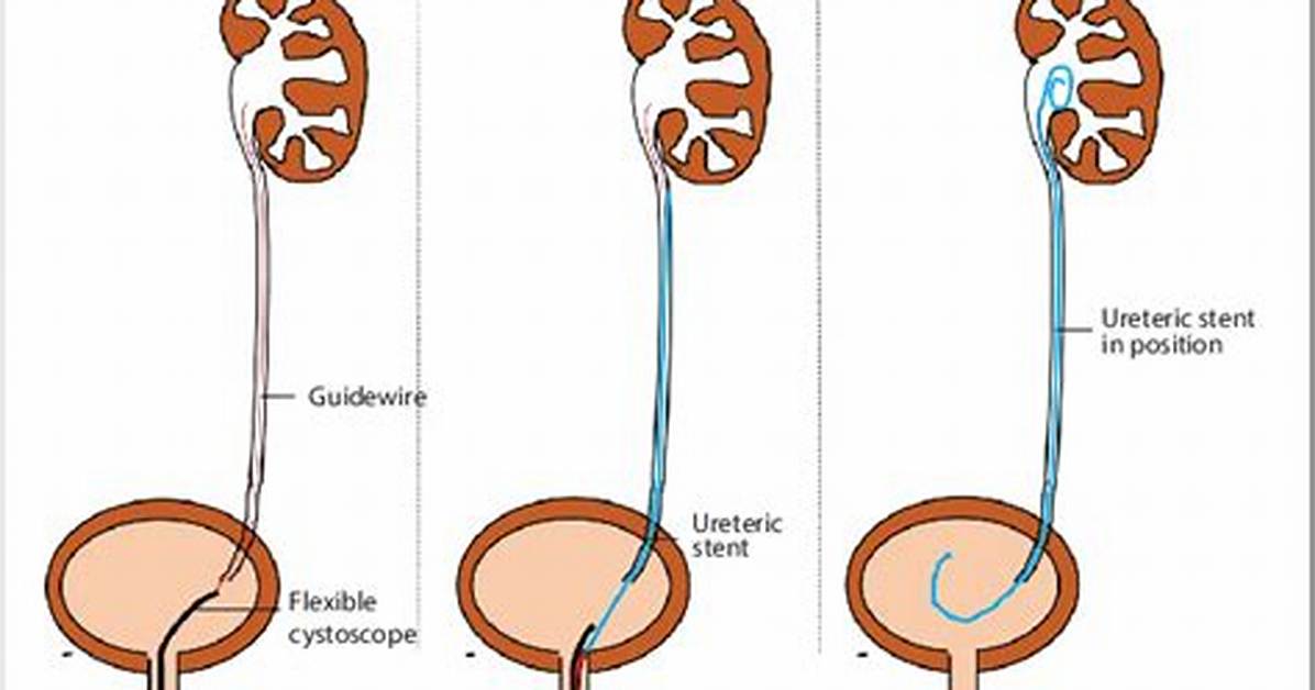 Does Ureteroscopy Require Stent?