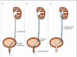 Does Ureteroscopy Require Stent?