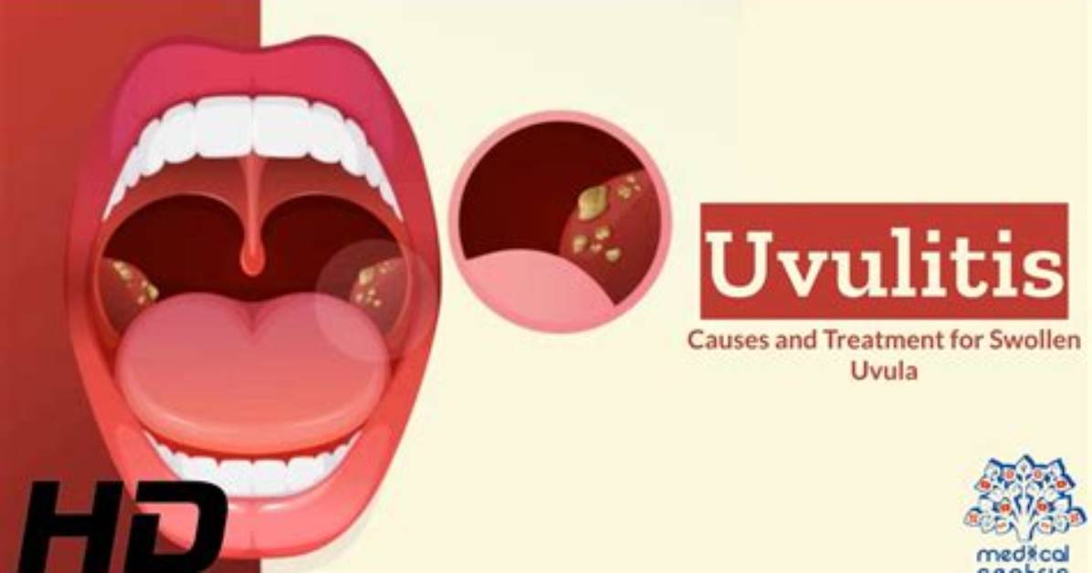 Does Uvulitis Require Antibiotics?