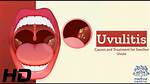 Does Uvulitis Require Antibiotics?