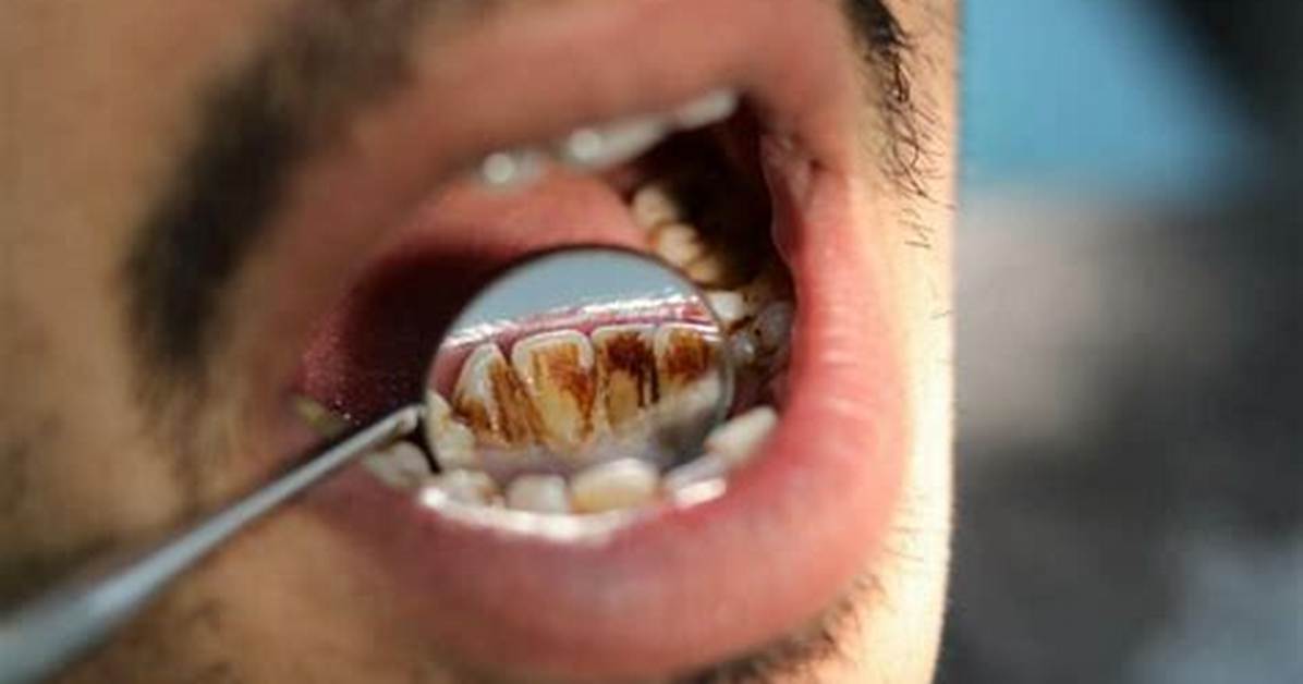 Does Vaping Stain Your Teeth?