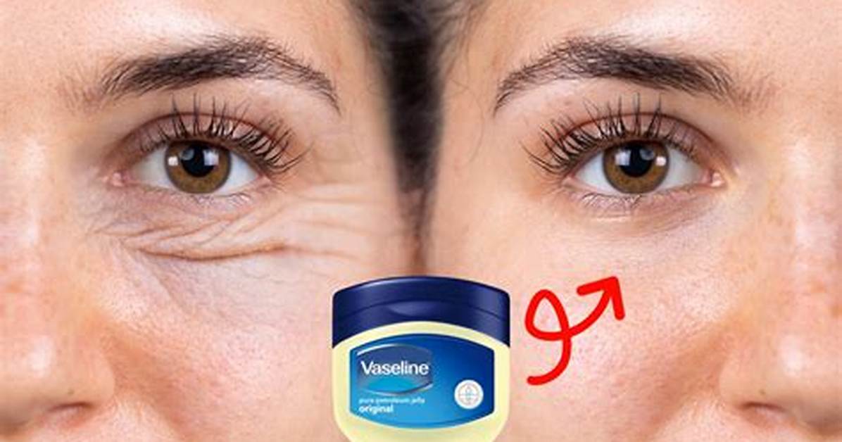 Does Vaseline Help Acne