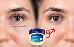 Does Vaseline Help Acne
