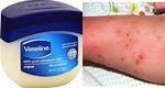 Does Vaseline Kill Scabies