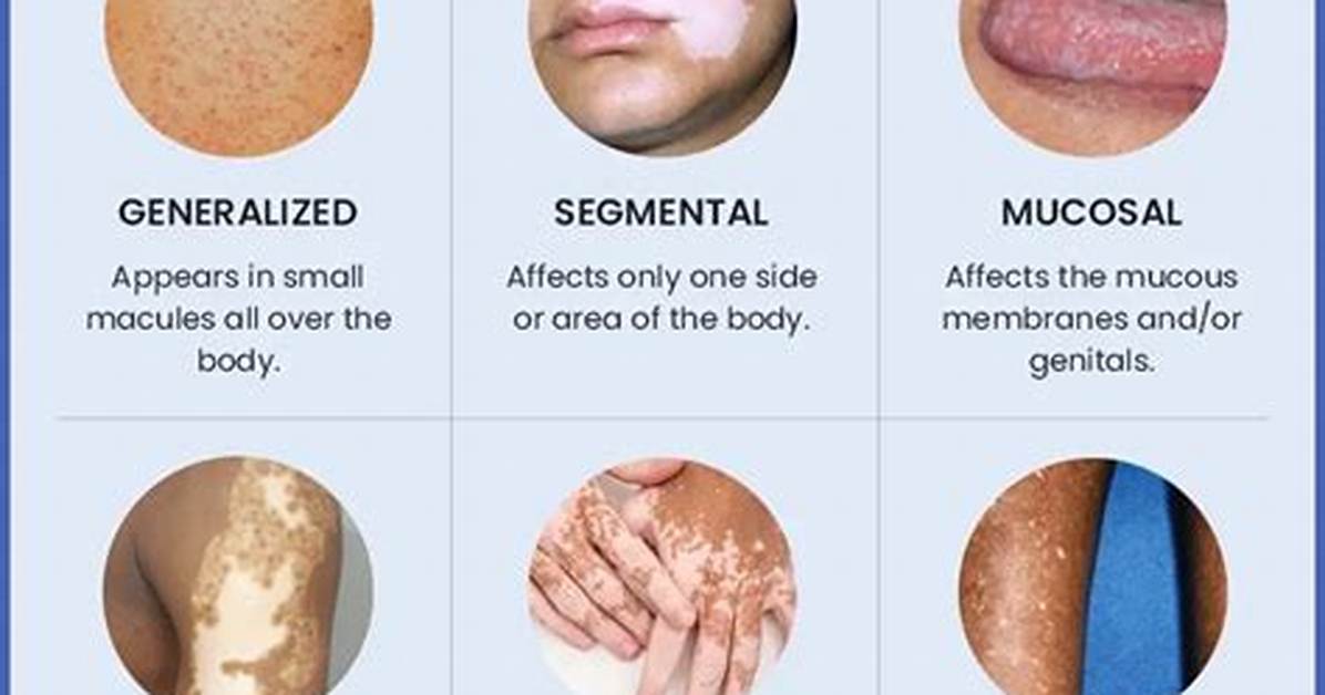 Does Vitiligo Always Spread?