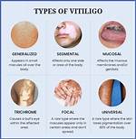 Does Vitiligo Always Spread?