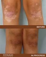 Does Vitiligo Go Away?