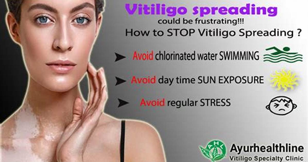 Does Vitiligo Stop Spreading?