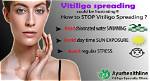 Does Vitiligo Stop Spreading?