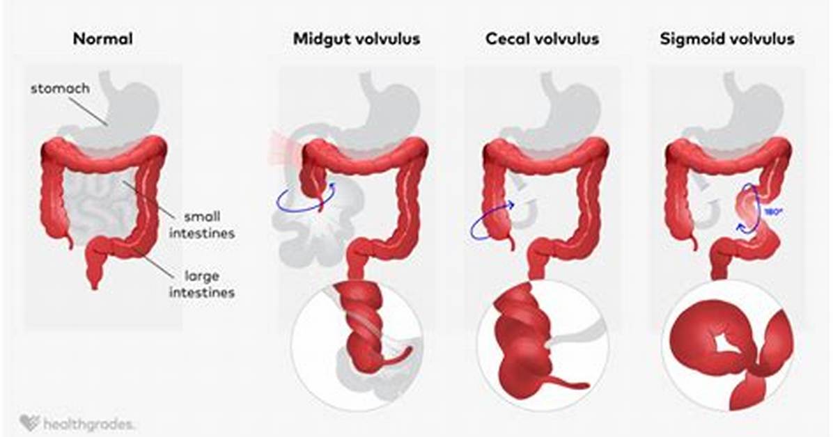 Does Volvulus Go Away?