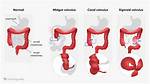 Does Volvulus Go Away?