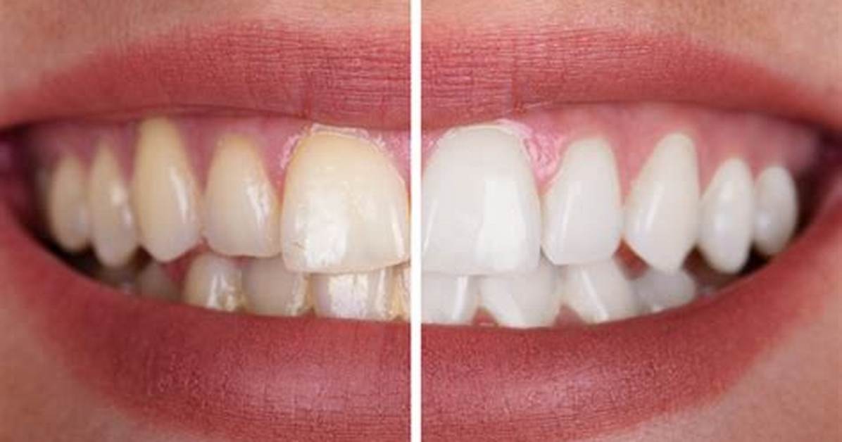 Does Whitening Damage Teeth?
