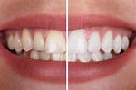 Does Whitening Damage Teeth?