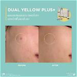 Does Yellow Correct Redness?