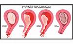 Does Your Chance of Miscarriage Decrease?
