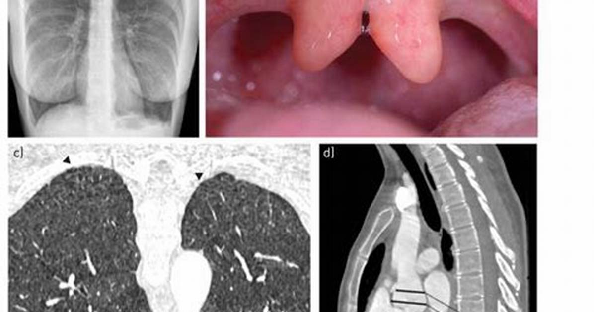 Double Uvula
