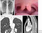 Double Uvula
