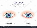 Droops