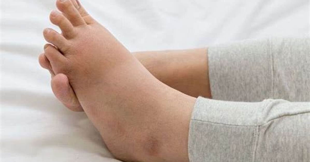 Dropsy Illness