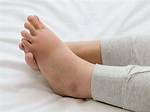 Dropsy Illness