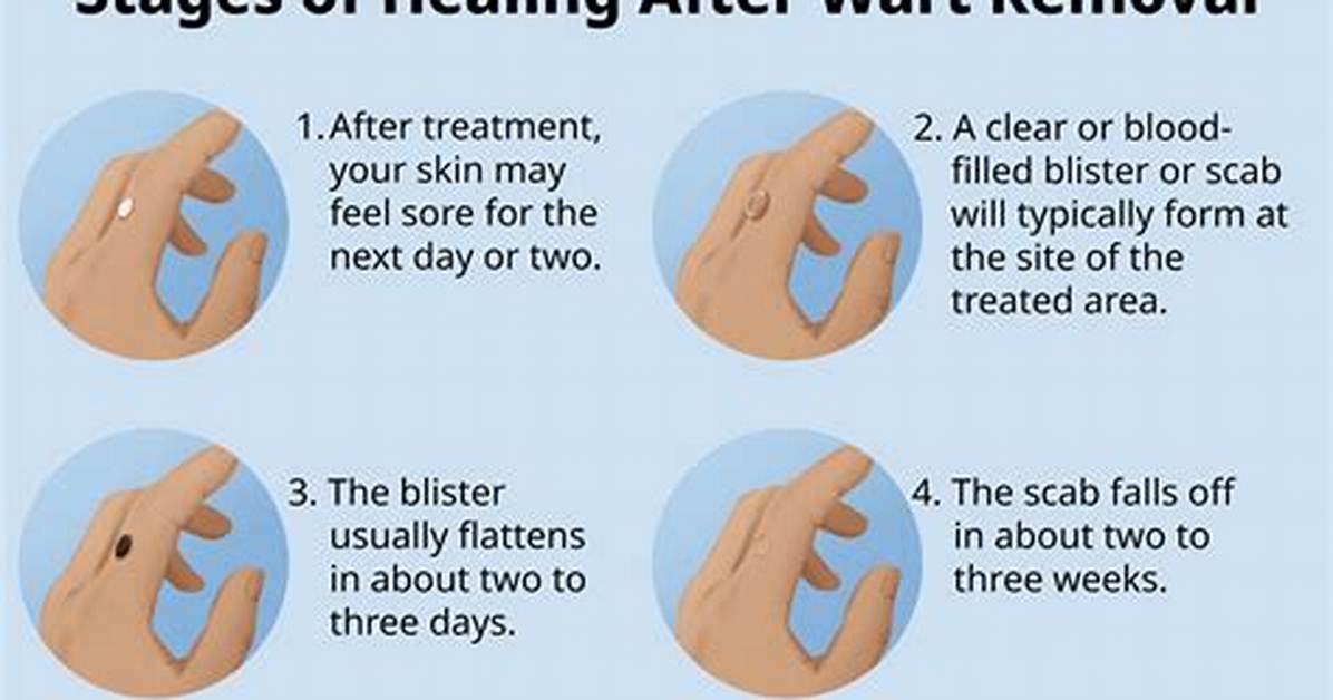 Dying Wart