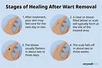 Dying Wart