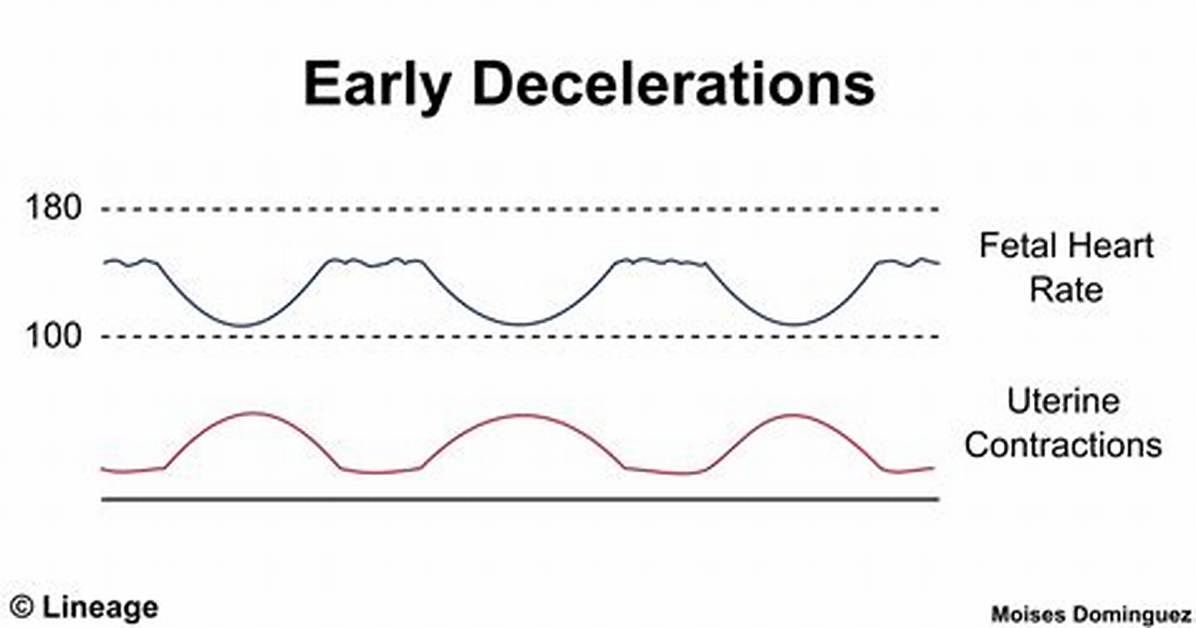 Early Decelerations