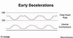 Early Decelerations