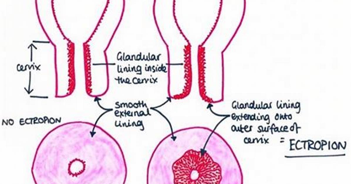 Ectropion Cervix