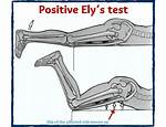 Ely’s Test