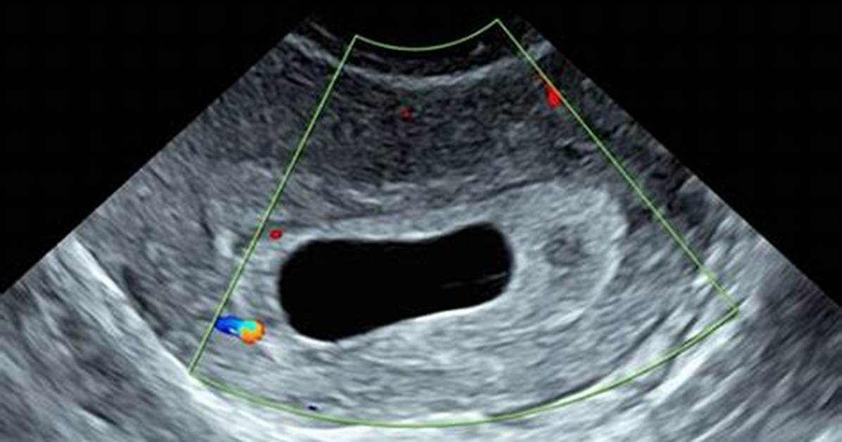 Empty Gestational Sac