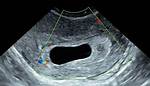 Empty Gestational Sac