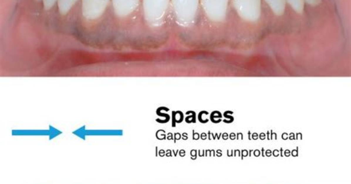 Empty Space Between Teeth Say