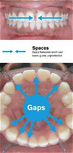 Empty Space Between Teeth Say