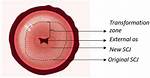 Endocervical/Transformation Zone Component Present