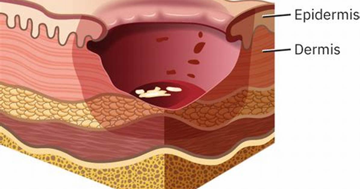 Epibole
