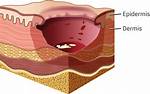 Epibole