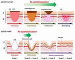 Epithelialization Definition