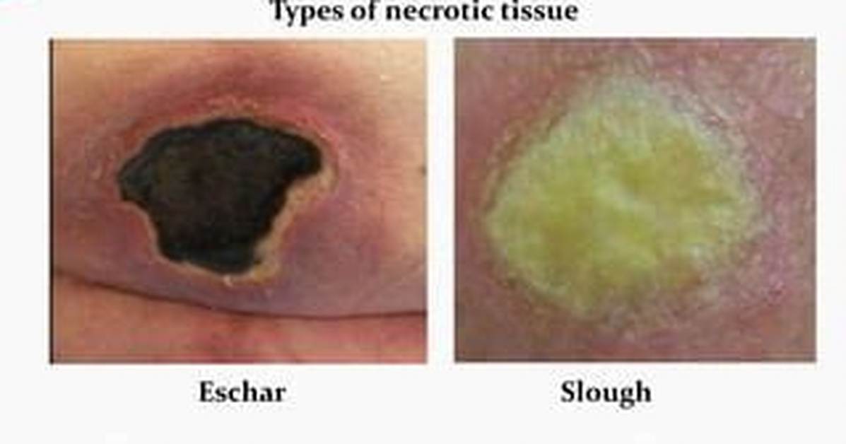Eschar Tissue
