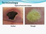 Eschar Tissue